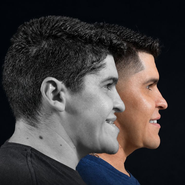 Cirurgia ortognática, caso 2, antes e depois