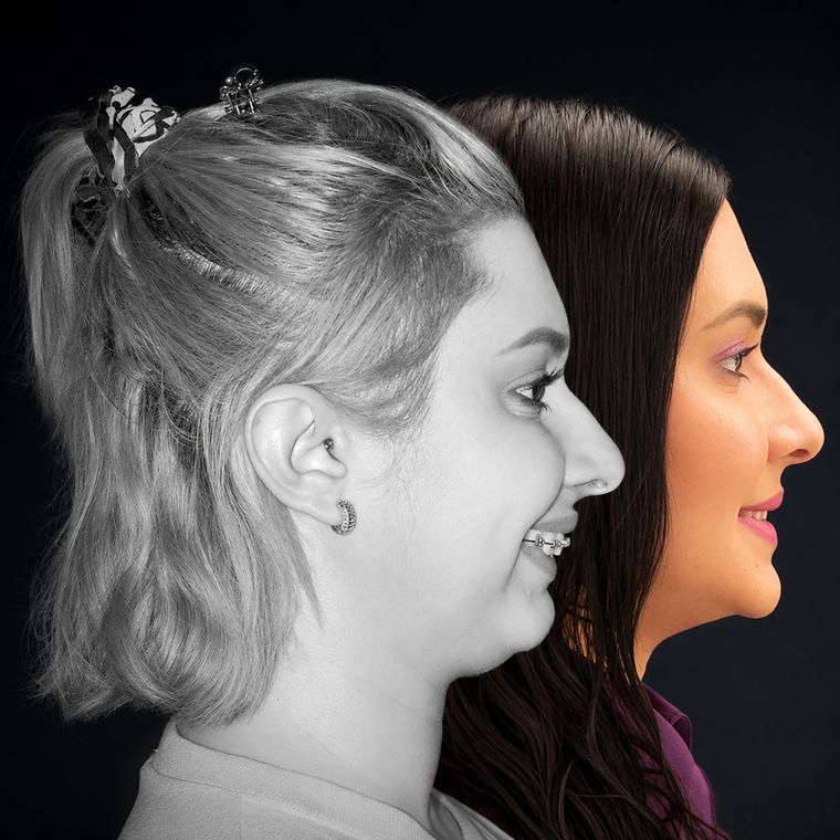 Cirurgia ortognática, caso 3, antes e depois