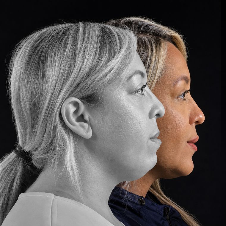 Cirurgia ortognática, caso 6, antes e depois