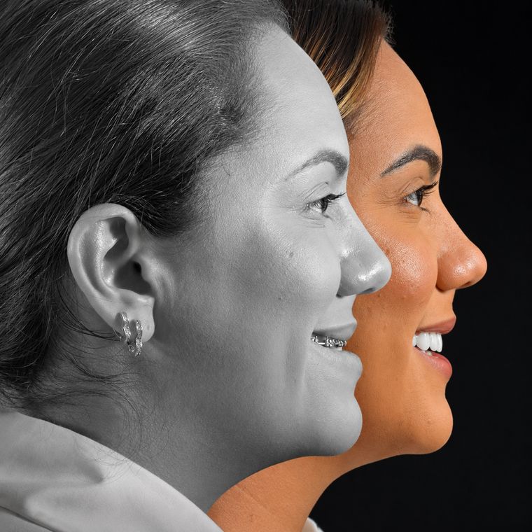 Cirurgia ortognática, caso 10, antes e depois