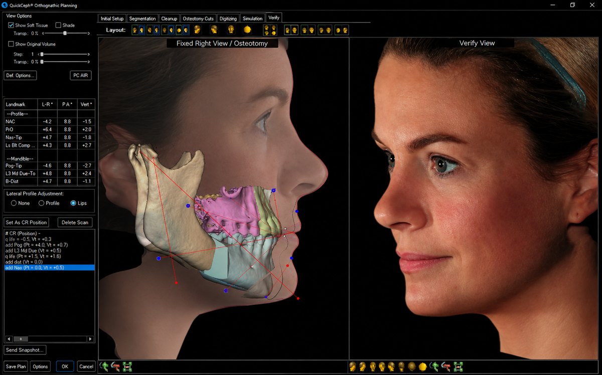 Planejamento virtual 3D da face, maxila e mandíbula para cirurgia ortognática